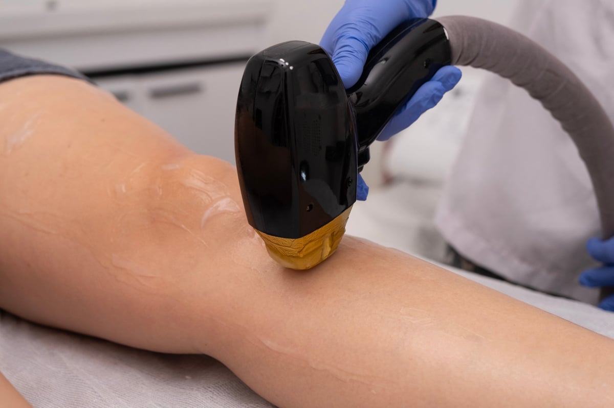 Epilazione laser Alessandrite - risultati duraturi per pelle liscia